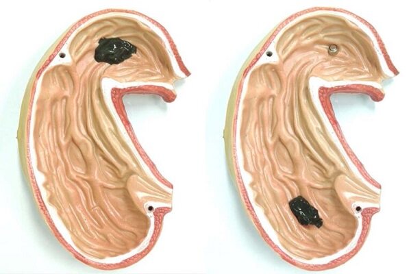 روبات اسلایمی زباله‌های بدن را می‌بلعد