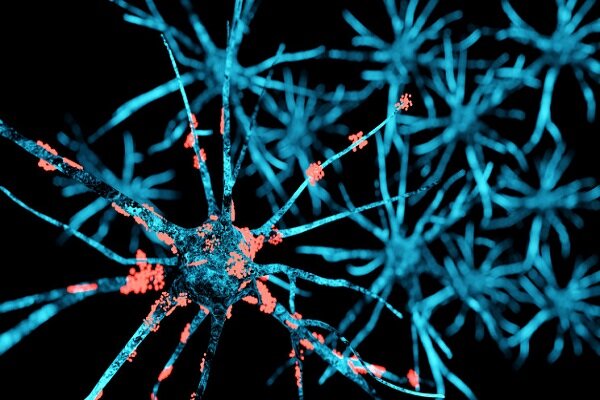 درمان جدیدی برای پارکینسون با کاشت ایمپلنت نخاعی