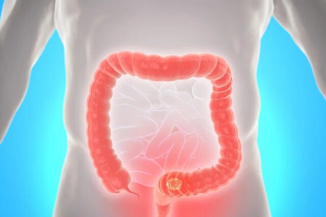۱۰ راه‌حل برای این‌که به سرطان روده بزرگ مبتلا نشوید