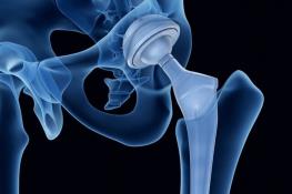 ساخت ایمپلنت‌های جدید با آلیاژ فلزی فوق الاستیک