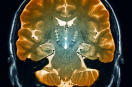 شناسایی سلول‌های مغزی مرتبط با بیماری پارکینسون