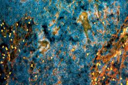 جهش ۱۰ ساله تحقیقات سرطان پروستات با یک کشف جدید