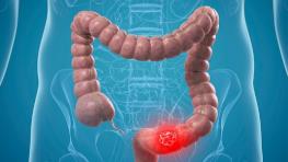 کولونوسکوپی بدون درد با روشی جدید