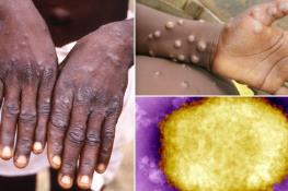 آیا آبله میمون، همچون کرونا به بیماری همه گیر بدل می‌شود؟ 