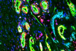 شناسایی یک هدف مولکولی جدید برای درمان سرطان