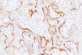 آسیب به جفت عامل مرده‌زایی در زنان مبتلا به کووید-۱۹